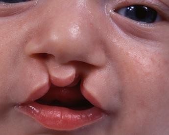 Cleft palate