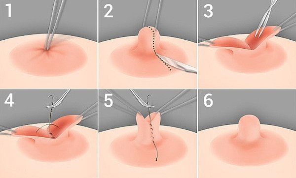 Retracted nipple correction