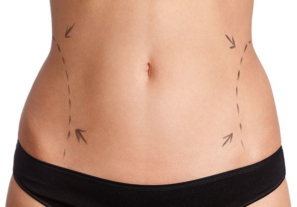 Laser liposuction