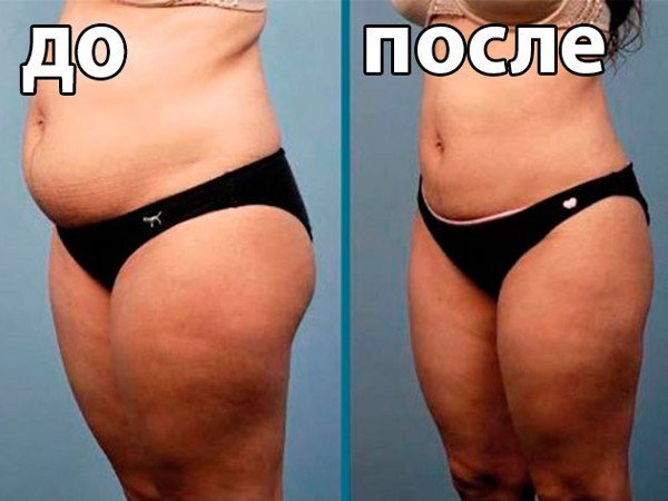 Liposuction surgery: results