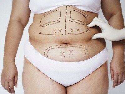 Liposuction for obesity