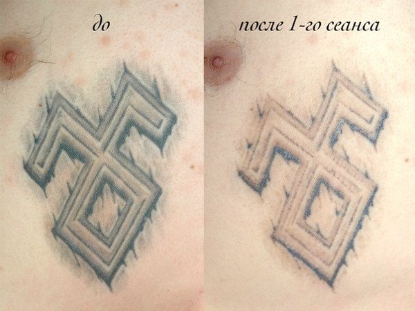 How does laser tattoo removal work?