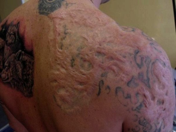 The consequences of unsuccessful laser tattoo removal