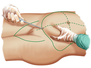 Indications for laser liposuction with cold laser