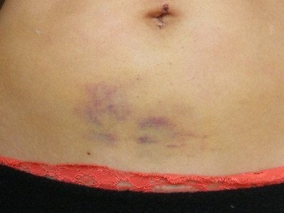 Bruises after liposuction