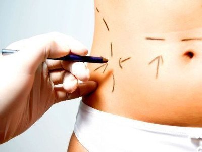 Is liposuction harmful?