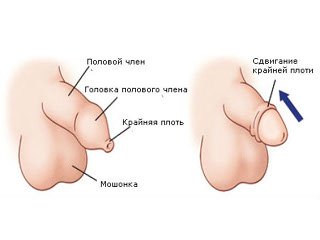 Plastic foreskin with phimosis