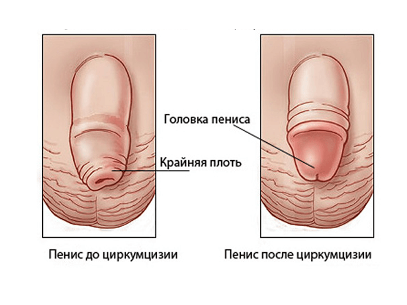 Circumcision of the penis