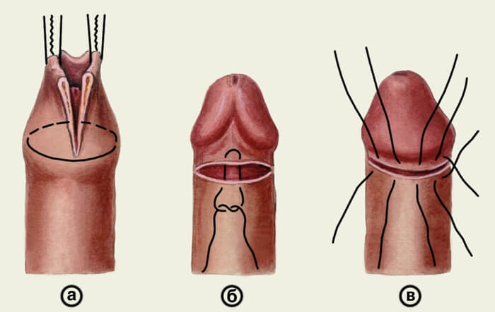 How does a member after circumcision