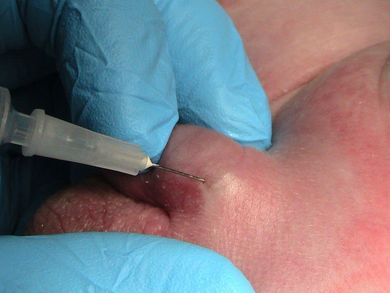 Circumcision of the penis: the course of the operation