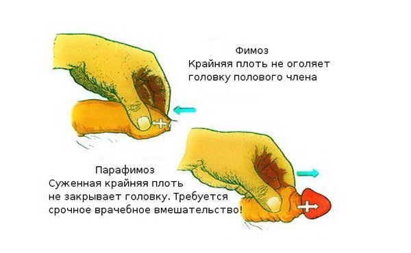 Medical indications for surgery circumcision