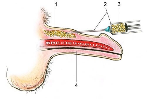 Penis thickening with injections