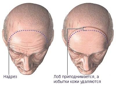 Coronary lifting of the forehead