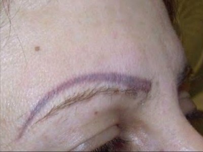 Laser eyebrow removal