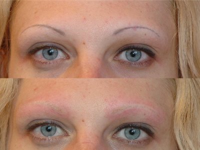 Laser eyebrow removal result