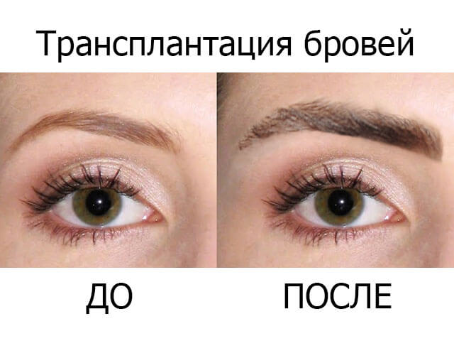 Before and after eyebrow transplantation