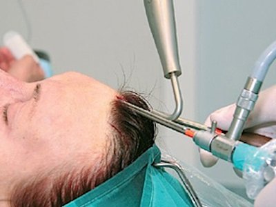 Endoscopic brow lift