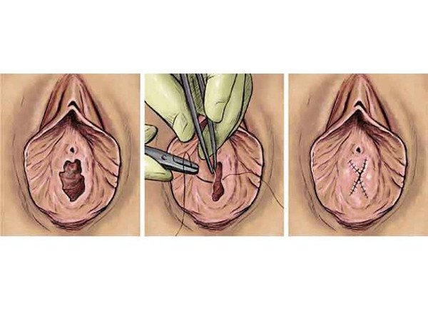 Surgery to restore virginity