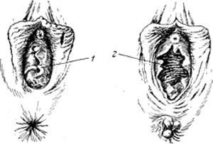 Hymenoplasty - surgery to restore the hymen