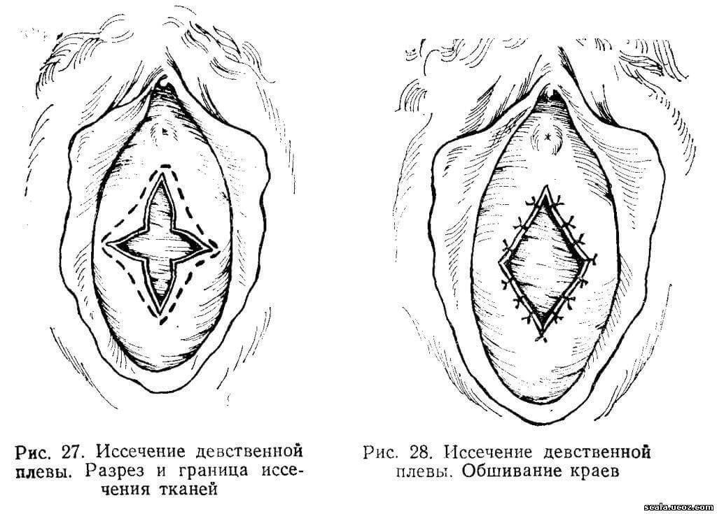 Restoration of virginity