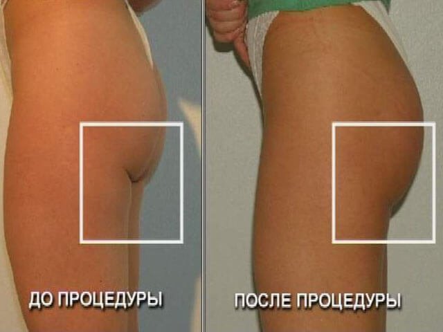 Before and after installing implants in the buttocks