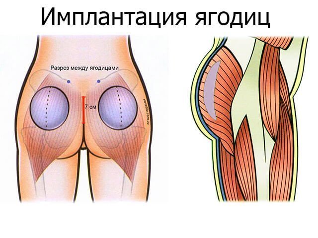 Buttock implantation surgery