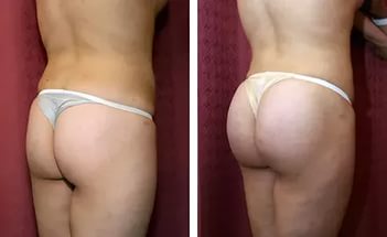 Buttock enlargement