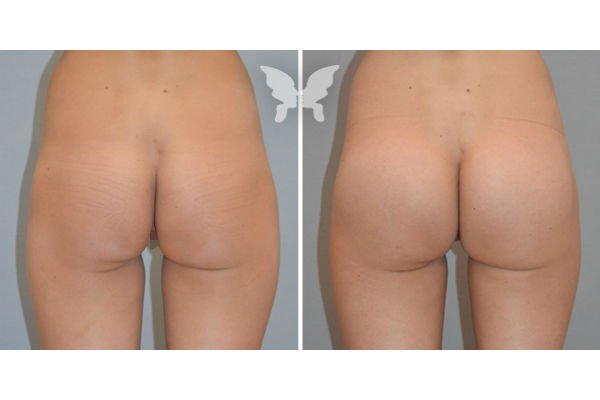 Buttock plastic surgery without implants is also possible.