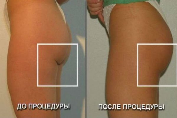 Surgical tightening of the buttocks