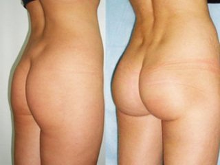 Lipofilling buttocks before and after