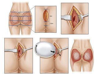 Buttock plastics