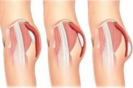 What is gluteoplasty