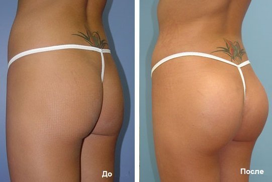 The result of gluteoplasty