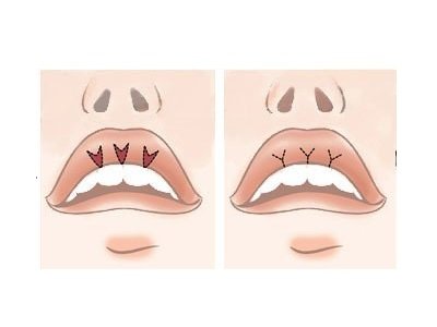 Surgical lip augmentation, VY plastic