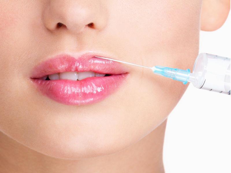 Upper lip augmentation procedure