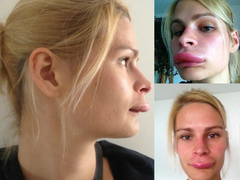 The effects of botox lip augmentation