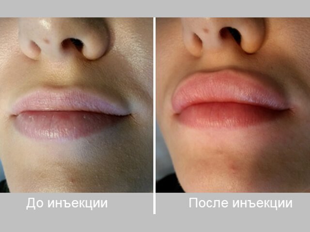 Before and after lip contour