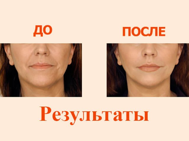 Restoring the shape of the lips in the elderly