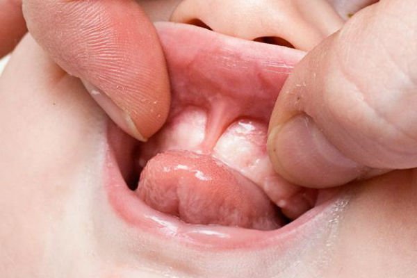 Short frenulum - the cause of speech disorders