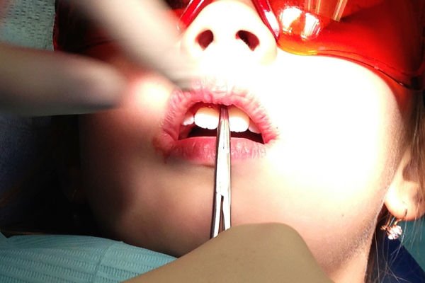 Surgery on the plastic of the upper lip in children