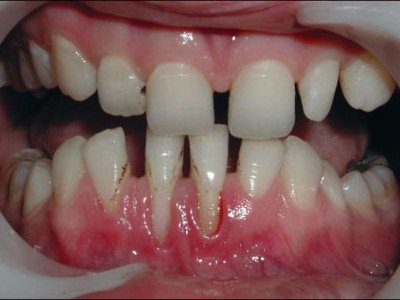 Diastema - indications for plastic lower lip bridles