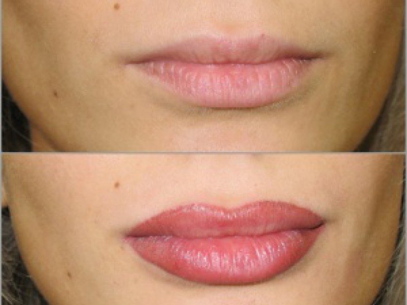 Lip augmentation with fillers