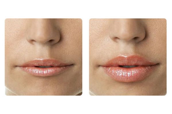 High-quality lip augmentation with anesthesia