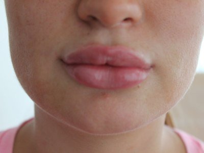 Edema after lip contouring