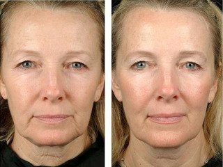 Facelift result