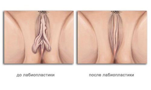 The result of the reduction of the labia minora