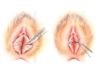 Laser Labioplasty Procedure