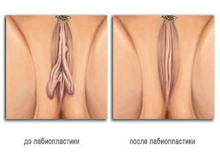 Correction of the labia minora