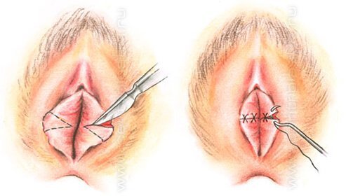 Plastic surgery of the labia or labioplasty