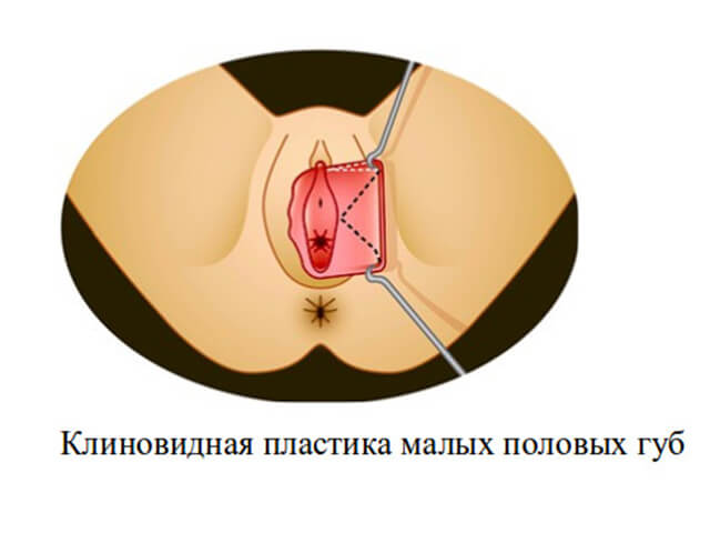 Wedge-shaped intimate plastic reduction of the labia